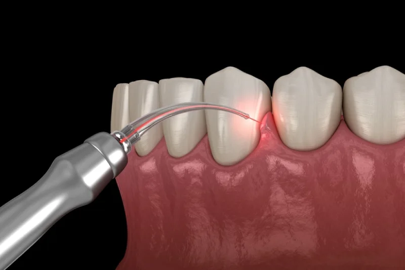 GN Dental Yuba City | Soft Tissue Periodontics