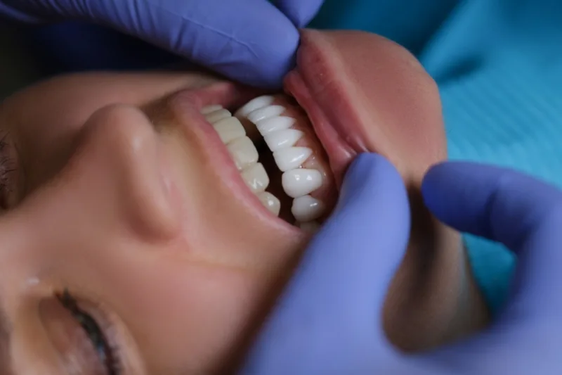 GN Dental Yuba City | Composite Veneers