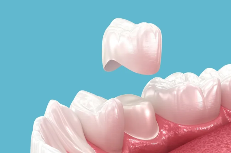 GN Dental Yuba City | Dental Crowns & Bridges