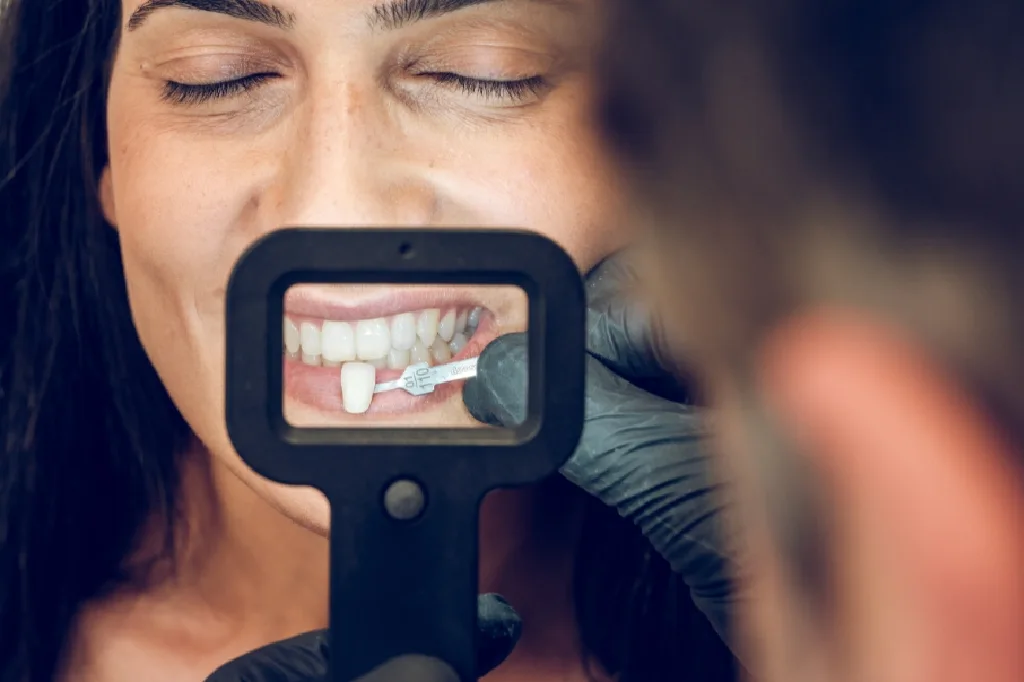 GN Dental Yuba City | Porcelain Veneers