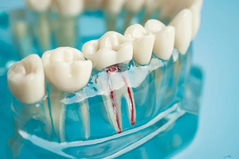 GN Dental Yuba City | Root Canal Therapy