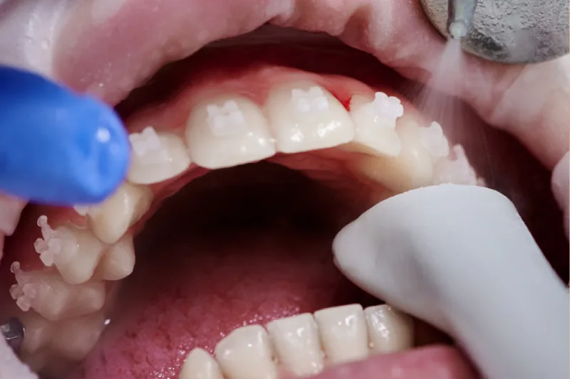 GN Dental Yuba City | Teeth Whitening / Cleaning