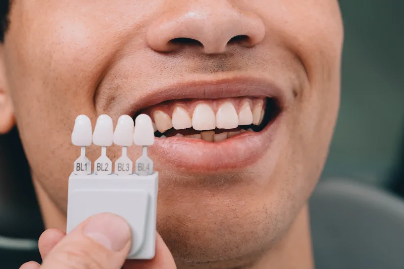 GN Dental Yuba City | Veneers