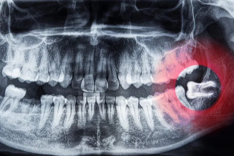 GN Dental Yuba City | Wisdom Teeth Removal