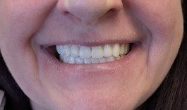 GN Dental Yuba City | Implant