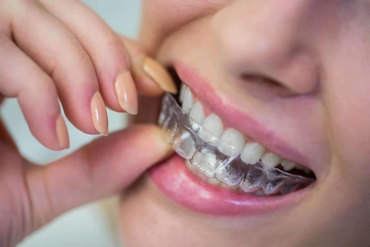 GN Dental Yuba City | Invisalign