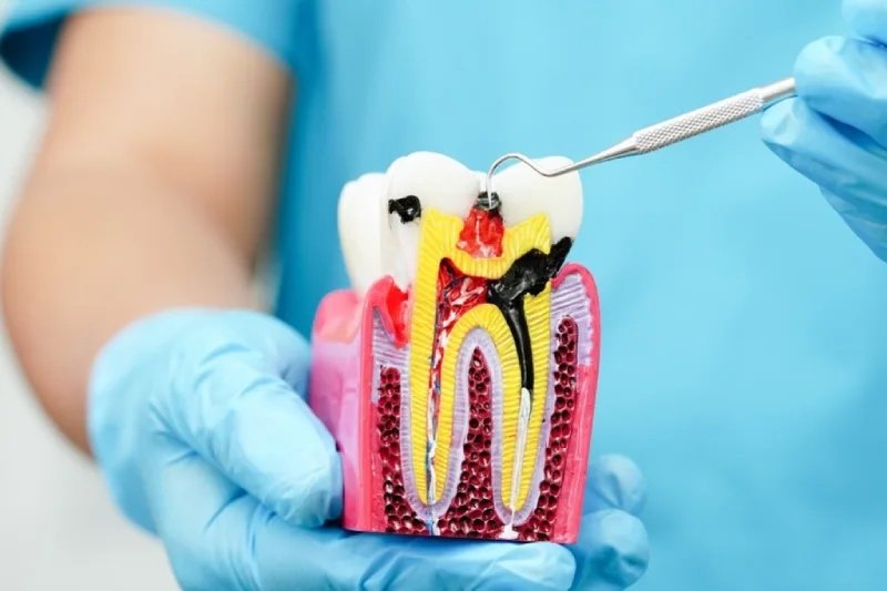 GN Dental Yuba City | Root Canal Therapy