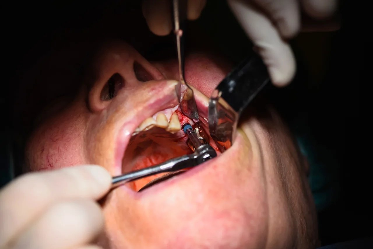 GN Dental Yuba City | Wisdom Teeth Removal