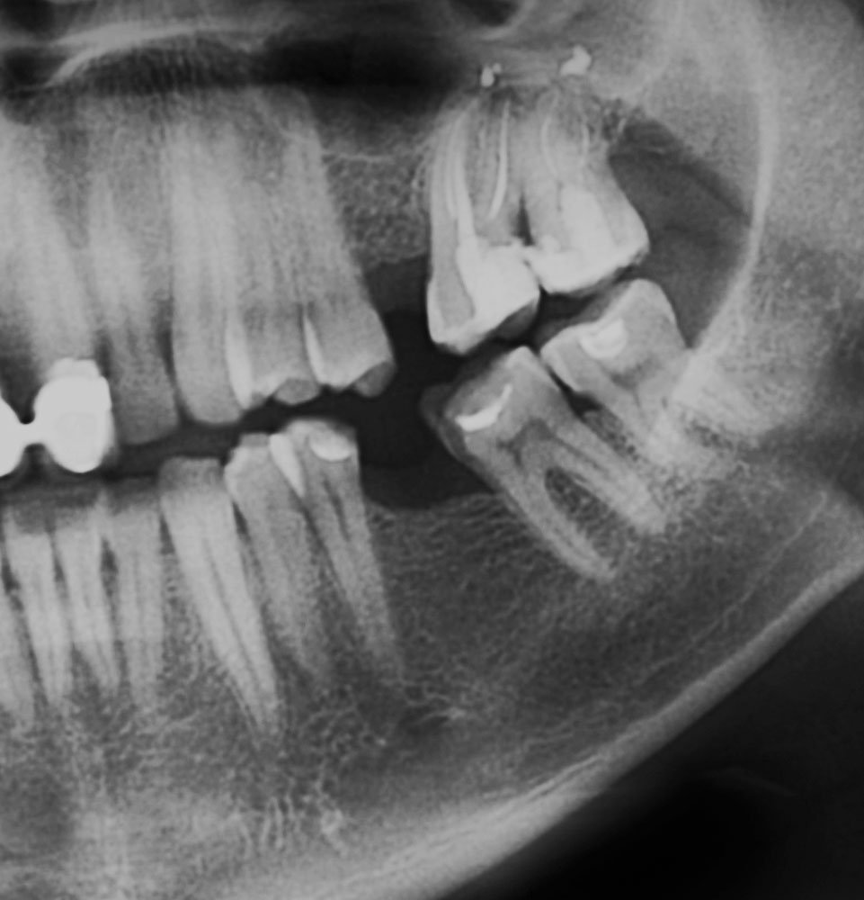 GN Dental Yuba City | Implant